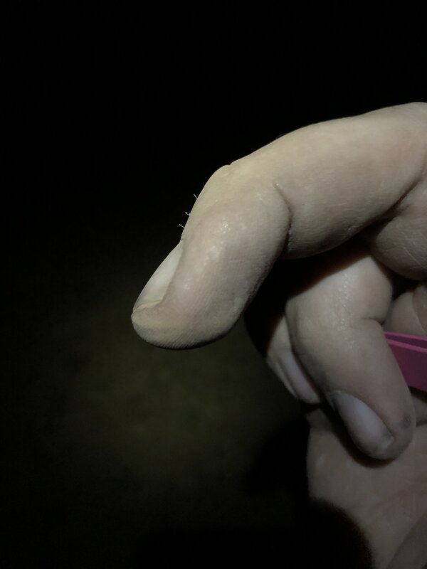Prickles in my finger